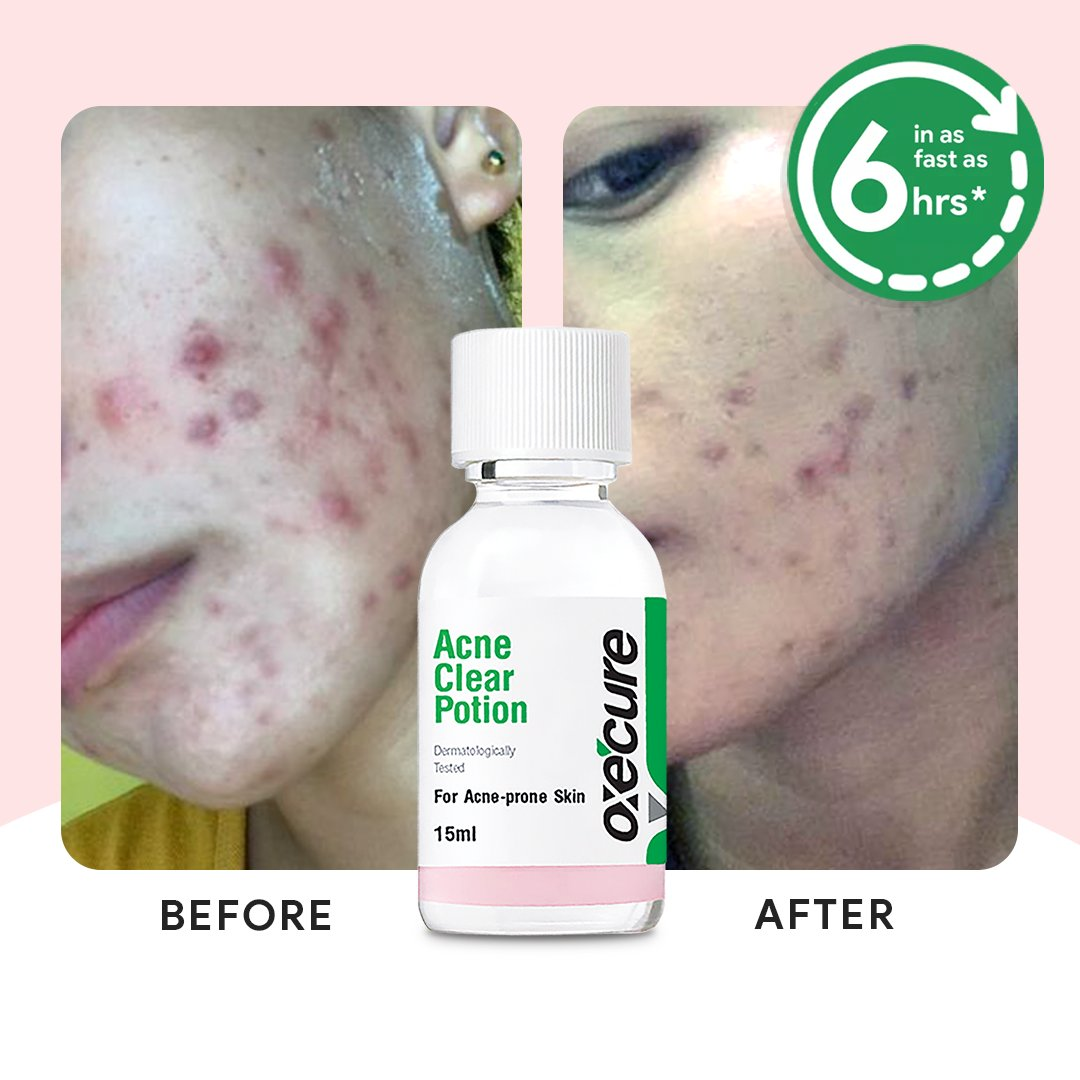 Oxecure Acne Clear Potion - 15ml