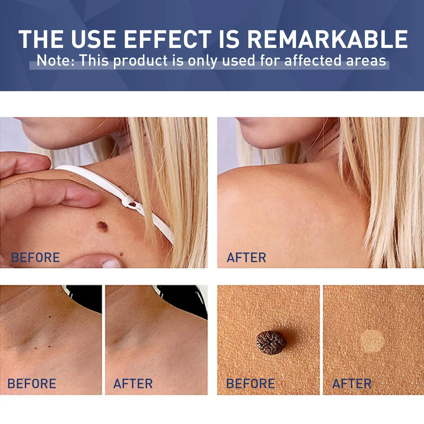 Jaysuing Skin Tag Remover - 20ml