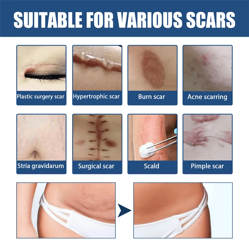 EELHOE Scars Eraser - 30g