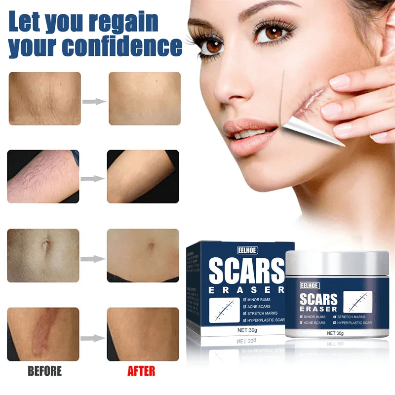 EELHOE Scars Eraser - 30g