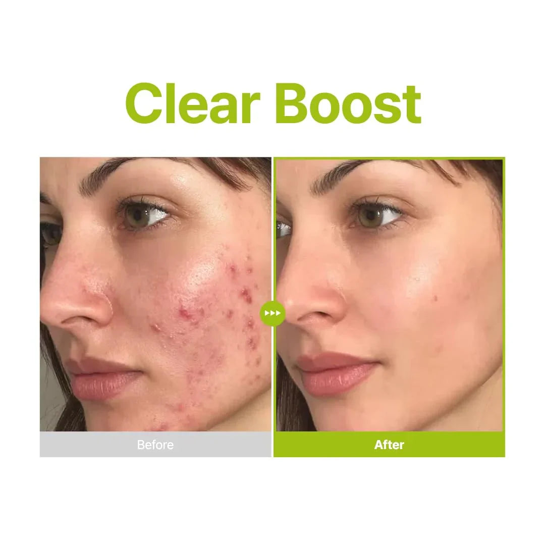 Purito Azelaic Acid 10 Kojic Tea Tree Facial Serum - 30ml