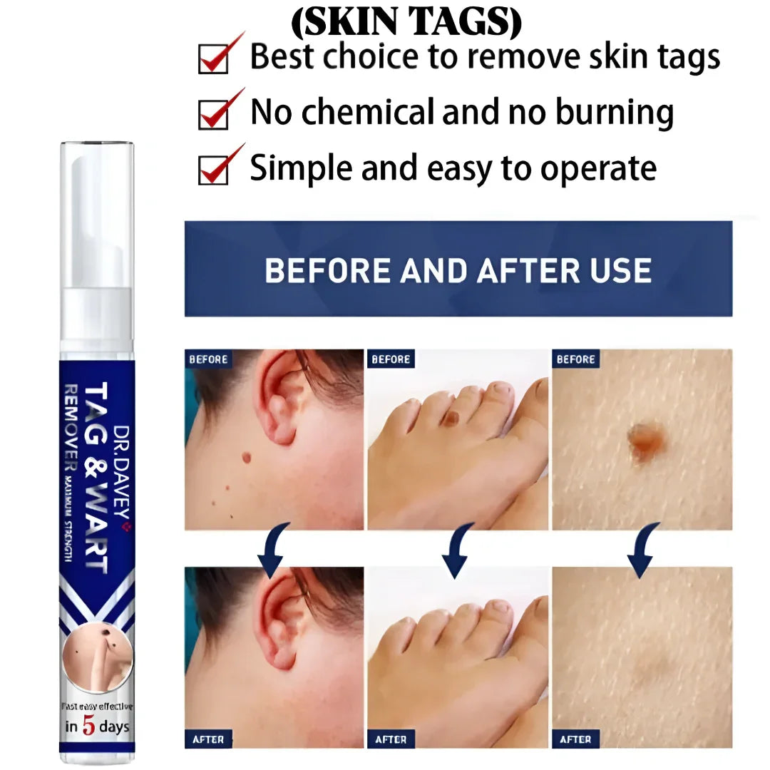 Dr. Davey Maximum Strength Tag & Wart Remover - 16ml