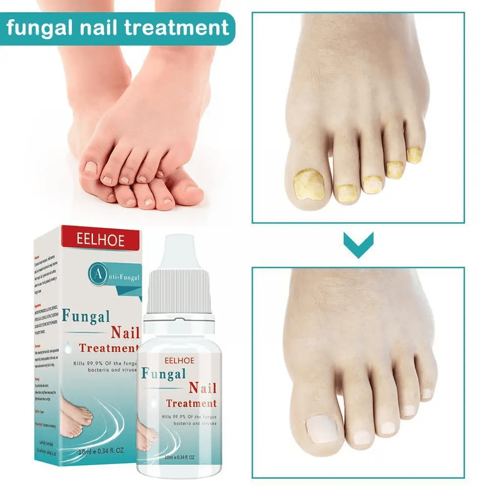 EELHOE Fungal Nail Treatment - 10ml