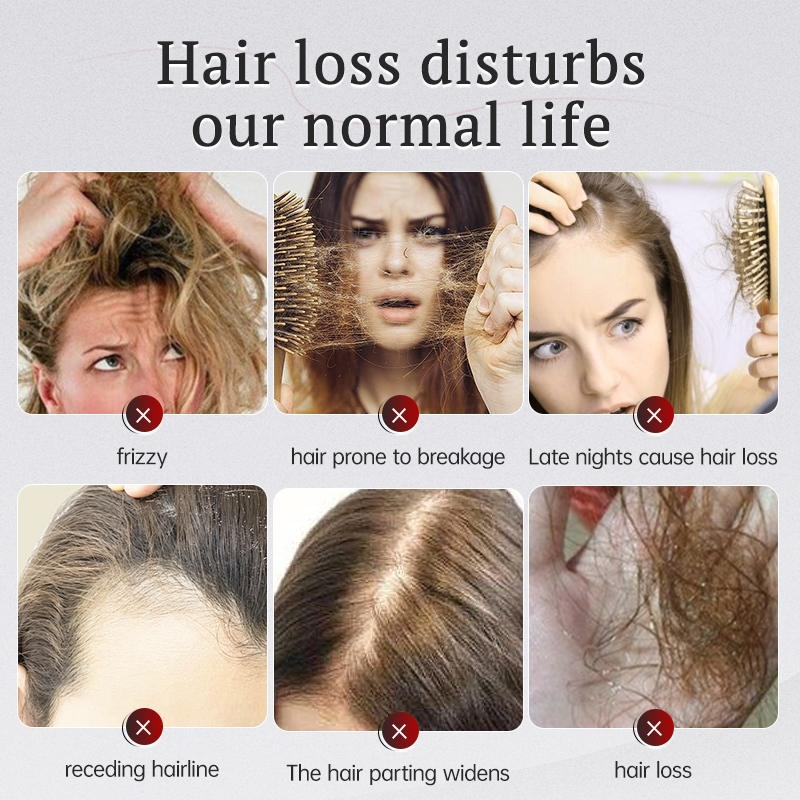 Kormesic 5% Minoxidil With Biotin Conditioner - 300ml