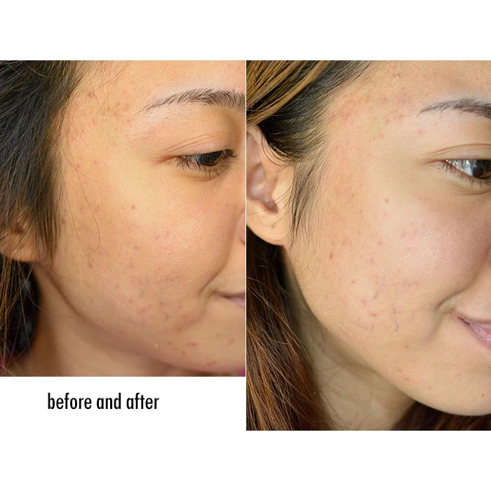 Belo AcnePro Pimple-Fighting Bar - 65g (1+1) Offer