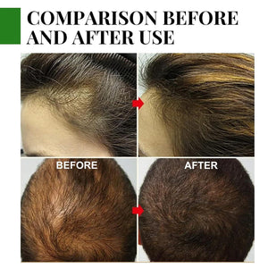 EELHOE Rosemary Oil for Hair Growth - Pinoyhyper