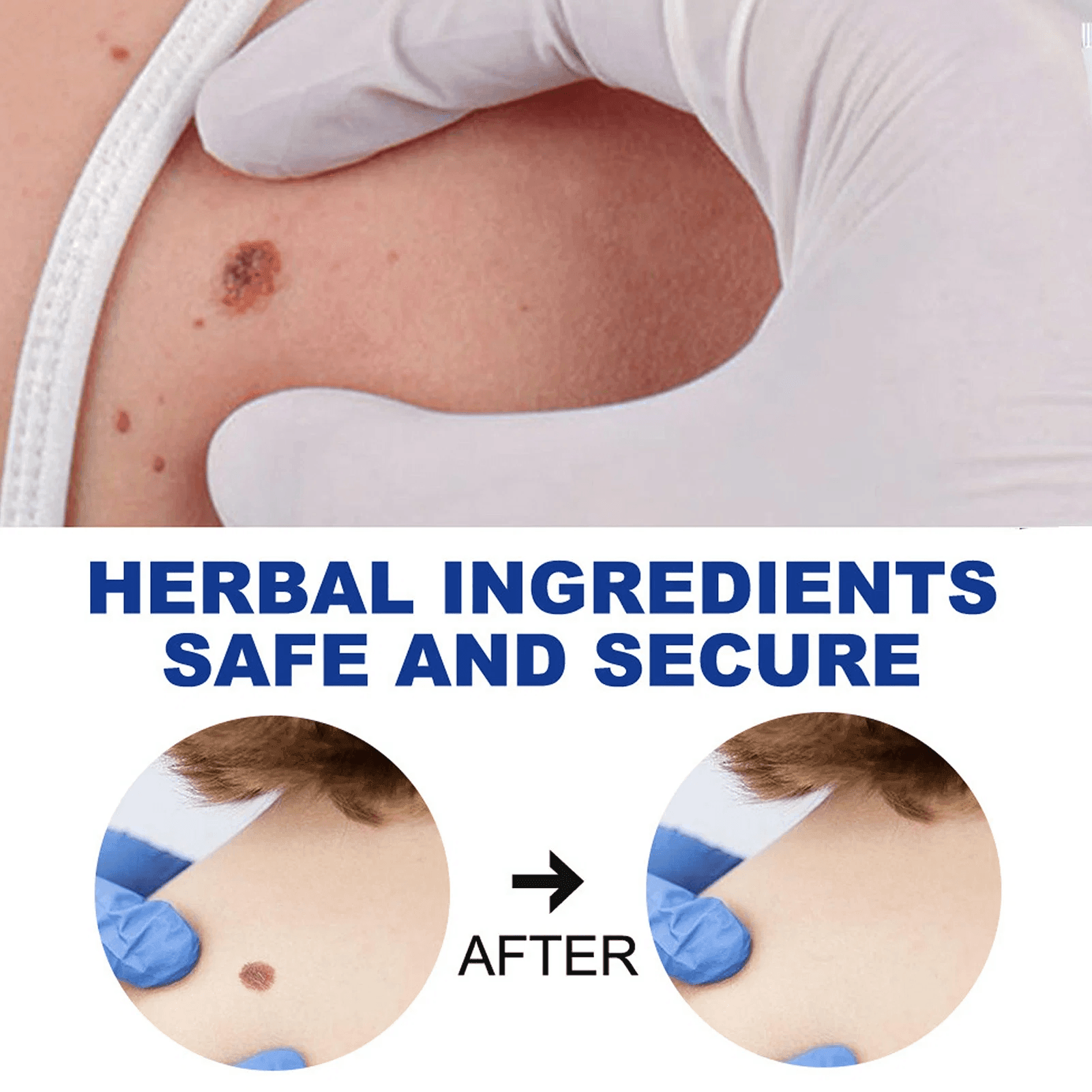 EELHOE Wart Remover Ointment - 20g - Pinoyhyper