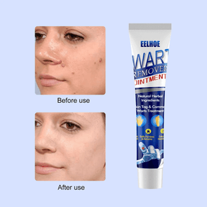 EELHOE Wart Remover Ointment - 20g - Pinoyhyper
