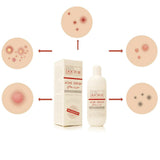 Skin Doctor Herbal Acne Serum - 10ml