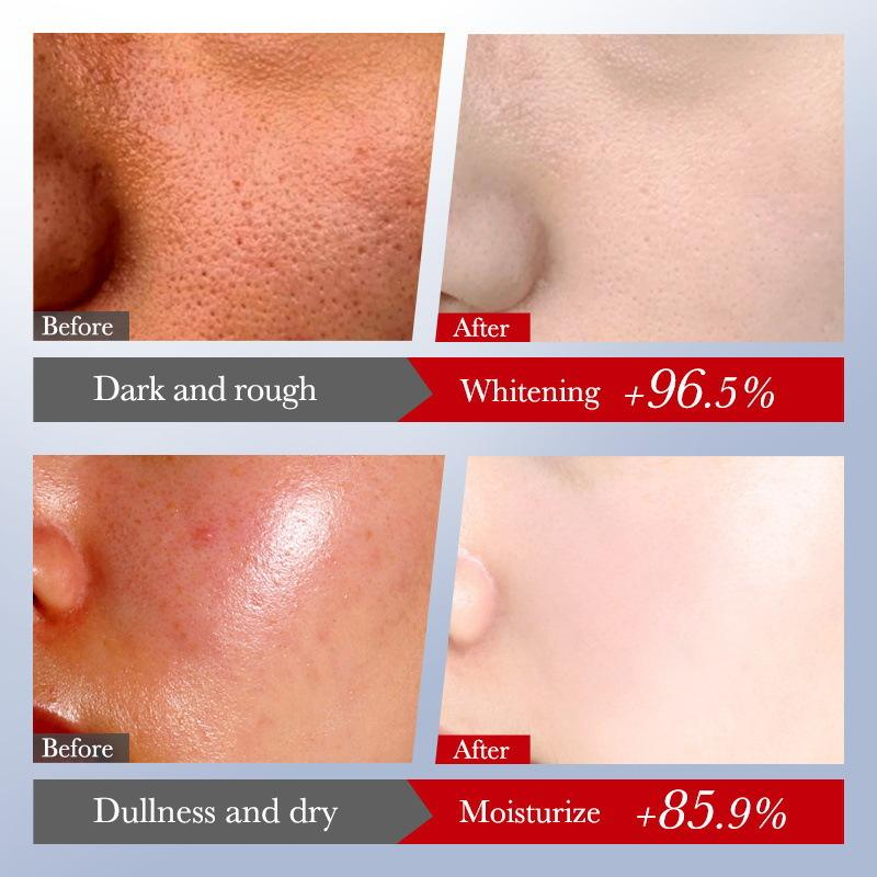 Sadoer Kojic Acid Anti-Freckles - 6 Pcs Set