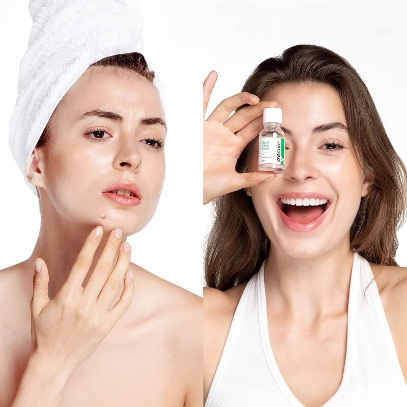 Oxecure Acne Clear Potion - 15ml