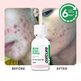 Oxecure Acne Clear Potion - 15ml