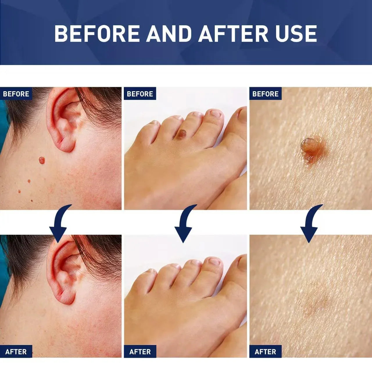Jaysuing Skin Tag Remover - 20ml