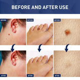 Jaysuing Skin Tag Remover - 20ml