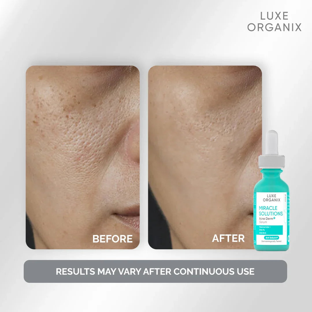 Luxe Organix Miracle Solution Acne Derm+ Serum - 30ml