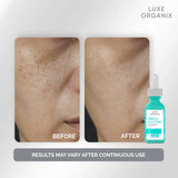 Luxe Organix Miracle Solution Acne Derm+ Serum - 30ml