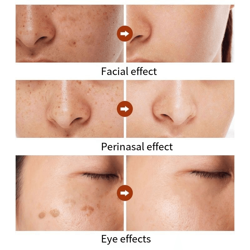 Hymey's Nicotinamide Anti Freckle Face Serum - 30ml