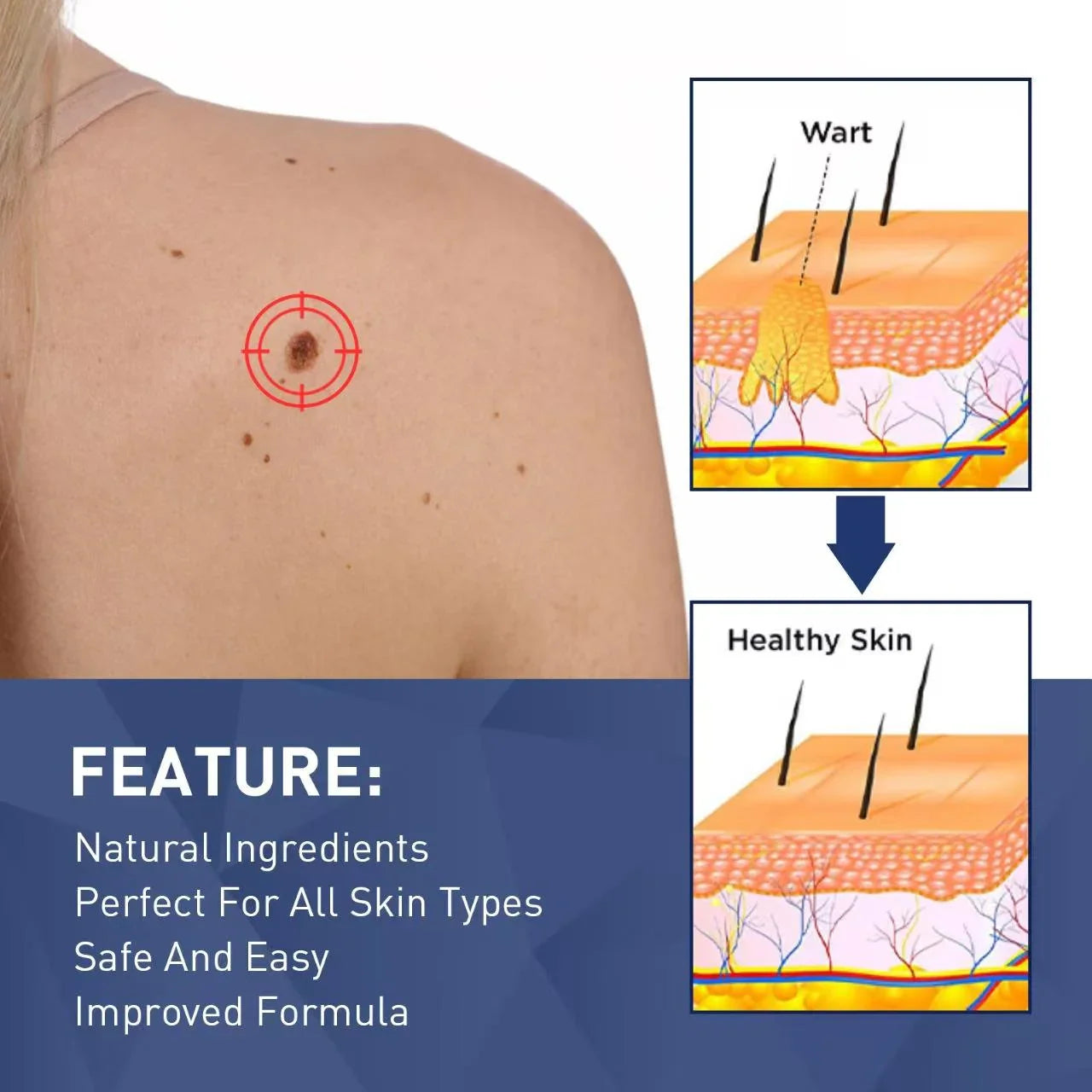 Jaysuing Skin Tag Remover - 20ml