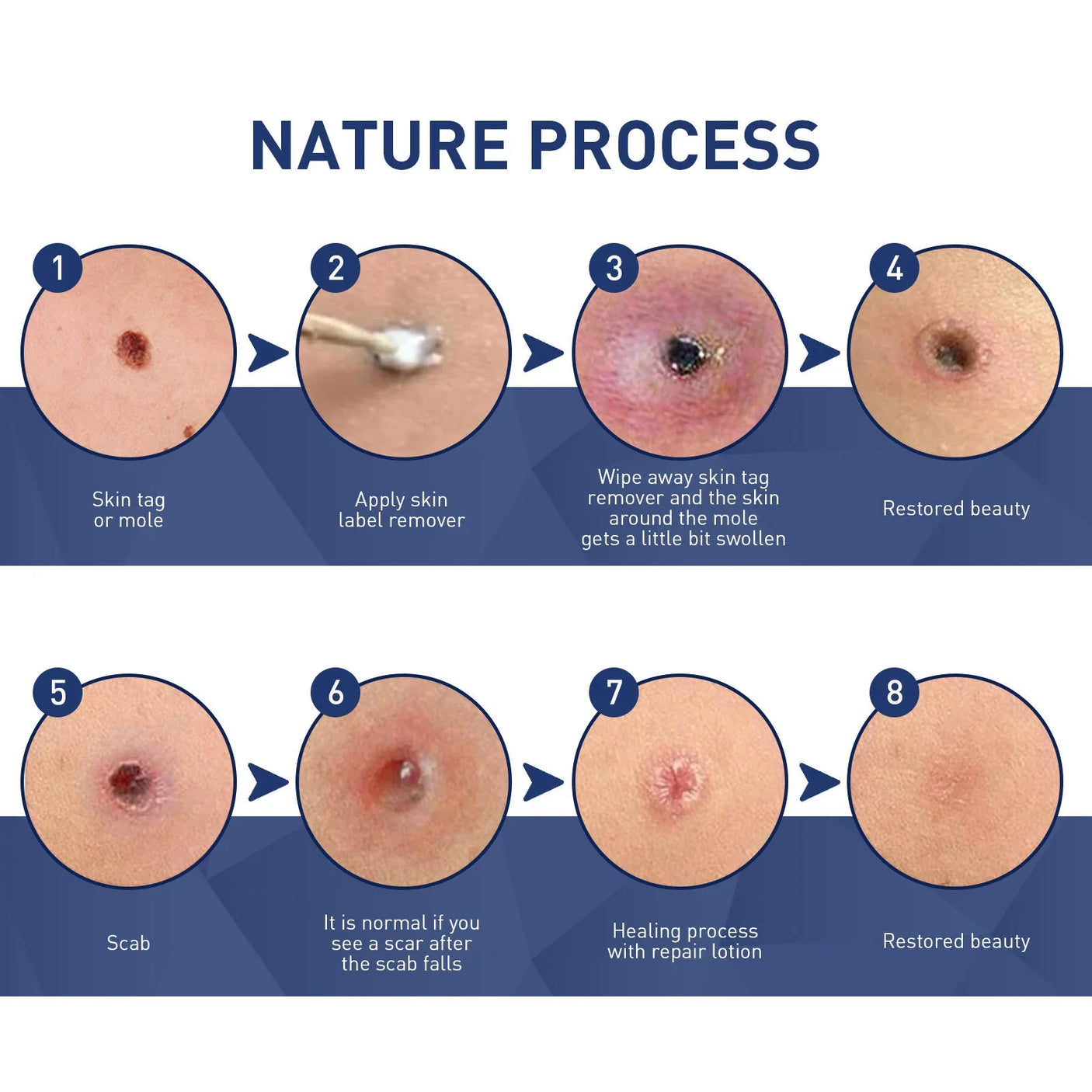 Jaysuing Skin Tag Remover - 20ml
