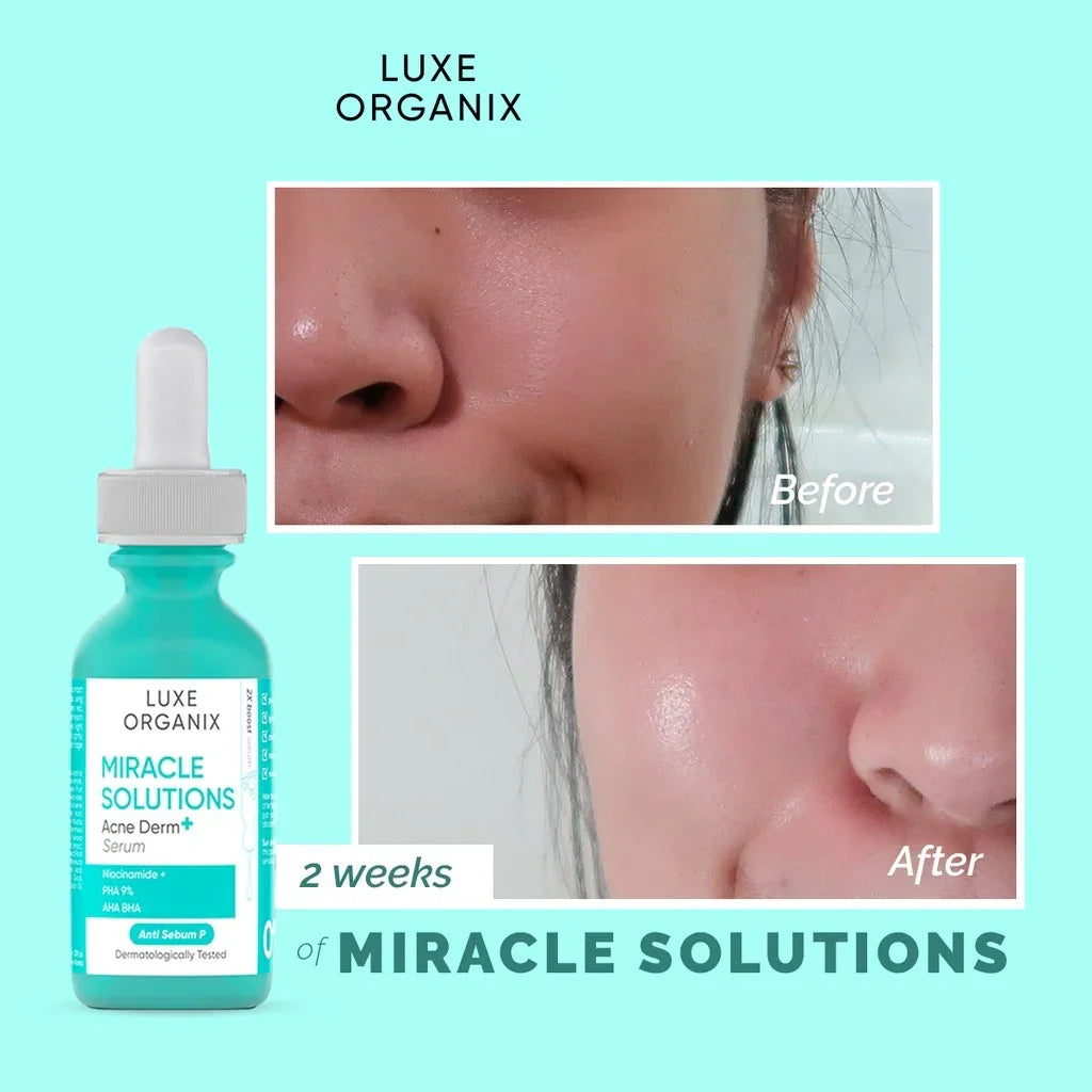 Luxe Organix Miracle Solution Acne Derm+ Serum - 30ml
