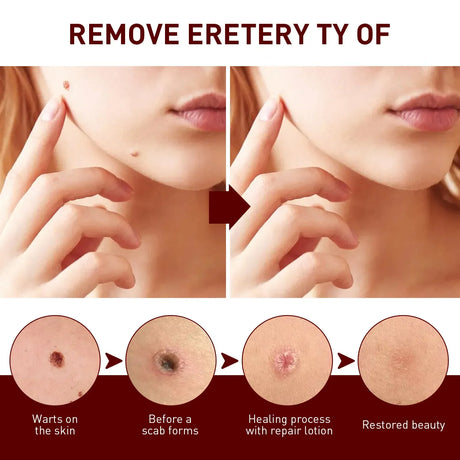 Jaysuing Liquid Warts Flat Eliminate - 3ml
