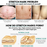 Vibrant Glamour Stretch Marks Remover Cream - 30g