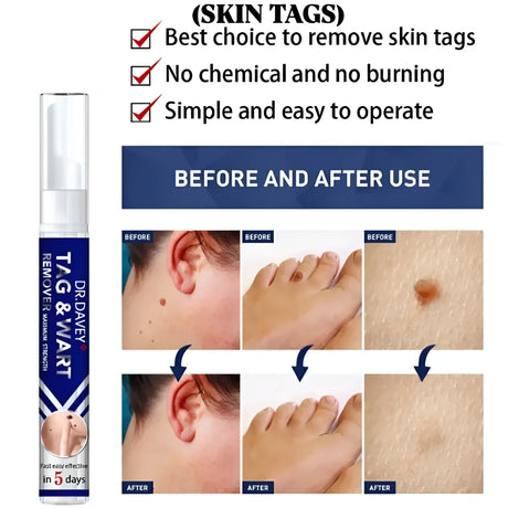 Dr. Davey Maximum Strength Tag & Wart Remover - 16ml