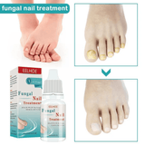 EELHOE Fungal Nail Treatment - 10ml