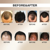 Kormesic 5% Minoxidil With Biotin Hair Regrowth Serum - 30ml