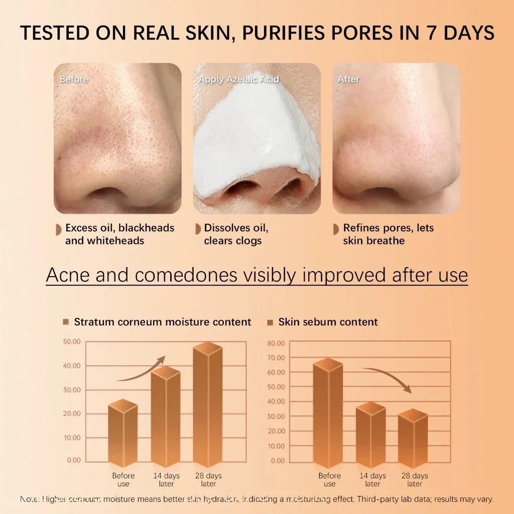 Skinoren Azelaic Acid 20% Anti-Acne Cream - 30g