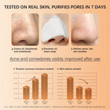 Skinoren Azelaic Acid 20% Anti-Acne Cream - 30g