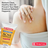 De La Cruz Maximum Strength Acne Treatment - 74g