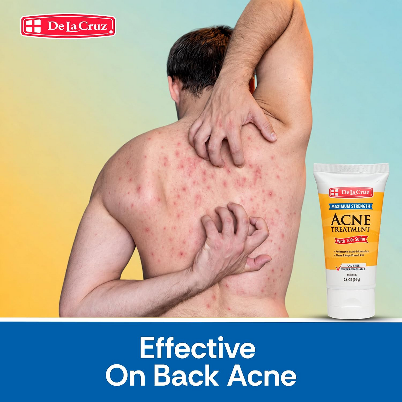 De La Cruz Maximum Strength Acne Treatment - 74g
