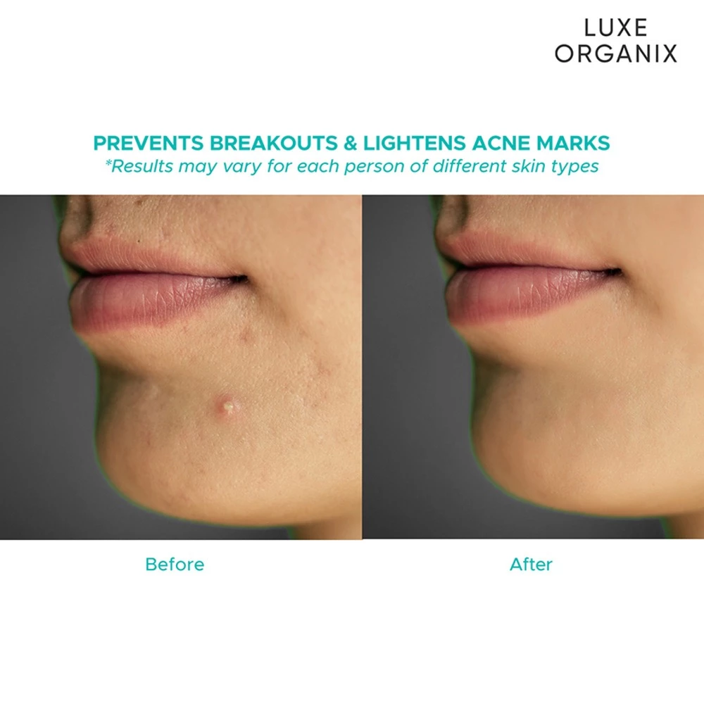 Luxe Organix Miracle Solutions Acne Derm+ Pimple Corrector - 20g