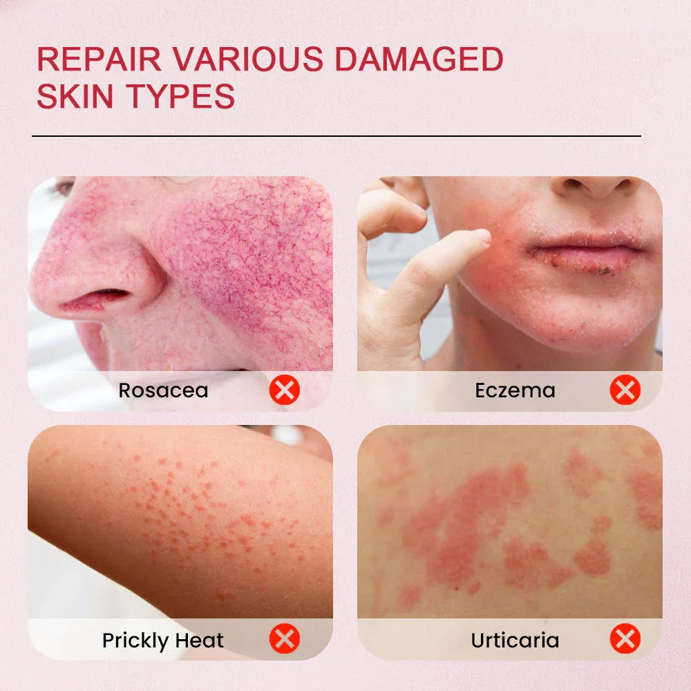 Sumifun Calamine Eczema Relief Cream - 20g