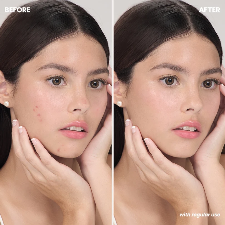 Luxe Organix Miracle Solutions Acne Derm+ Pimple Corrector - 20g