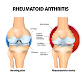 South Moon Joint Pain Relieves Rheumatoid Arthritis Miracle Cream - 20g
