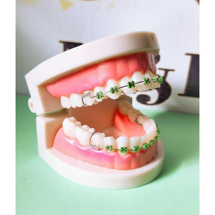 Fashion Braces For Upper & Lower Teeth - Pinoyhyper