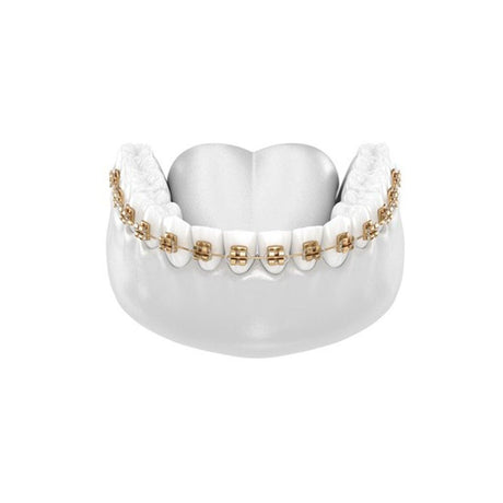Fashion Braces For Upper & Lower Teeth - Pinoyhyper