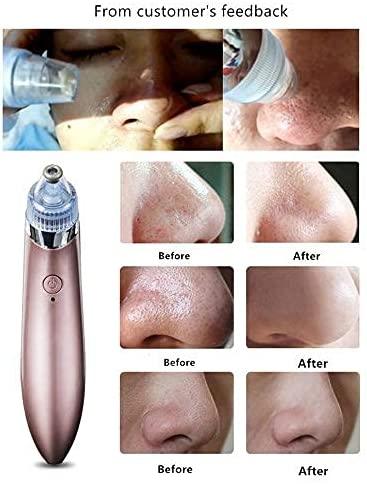 Acne pore cleaner Vacuum negative pressure easy pimple removing - JB8620 - Pinoyhyper