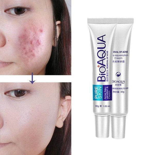 Bioaqua face cream skin care anti acne treatment cream 30g -100% ORIGINAL - Pinoyhyper