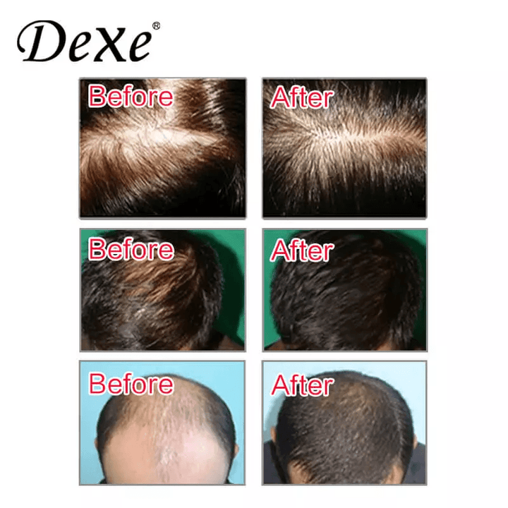 Dexe Anti-Hair Loss Lotion - 6mlx10 - Pinoyhyper