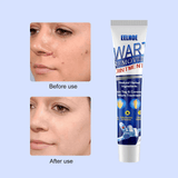 EELHOE Wart Remover Ointment - 20g - Pinoyhyper