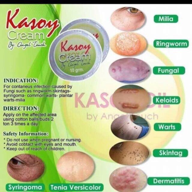 Kasoy Cream Warts Remover 10grm - Pinoyhyper