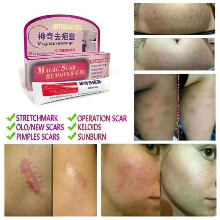 Magic Scar Remover Gel 40g - Pinoyhyper